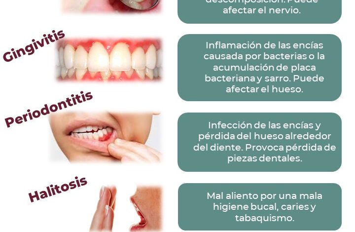  Informa IMSS Chihuahua qué enfermedades bucales empiezan con: caries, gingivitis, halitosis y periodontitis