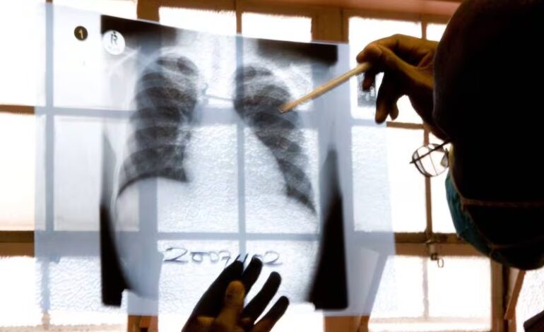  Aumento récord de casos de tuberculosis en EU en 2023