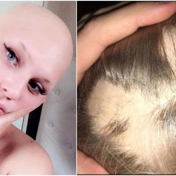 Novio convierte su cabello en una peluca para su pareja con alopecia y emociona a internet